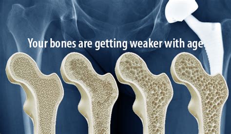 An illustration of bone density, highlighting its importance and factors that affect it